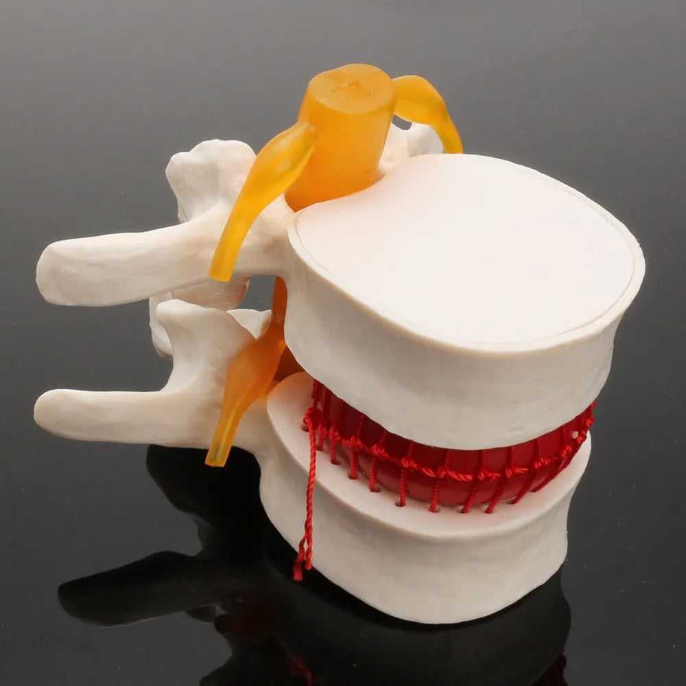 White PVC medical model of a lumbar intervertebral disc showing herniation.