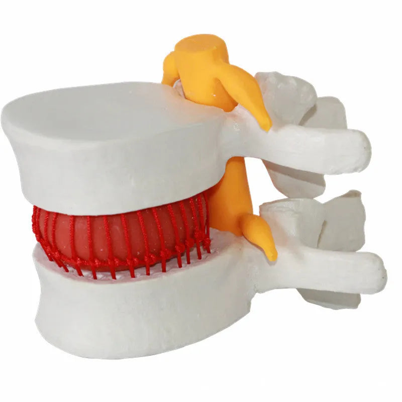 White PVC medical model of a lumbar intervertebral disc showing herniation.