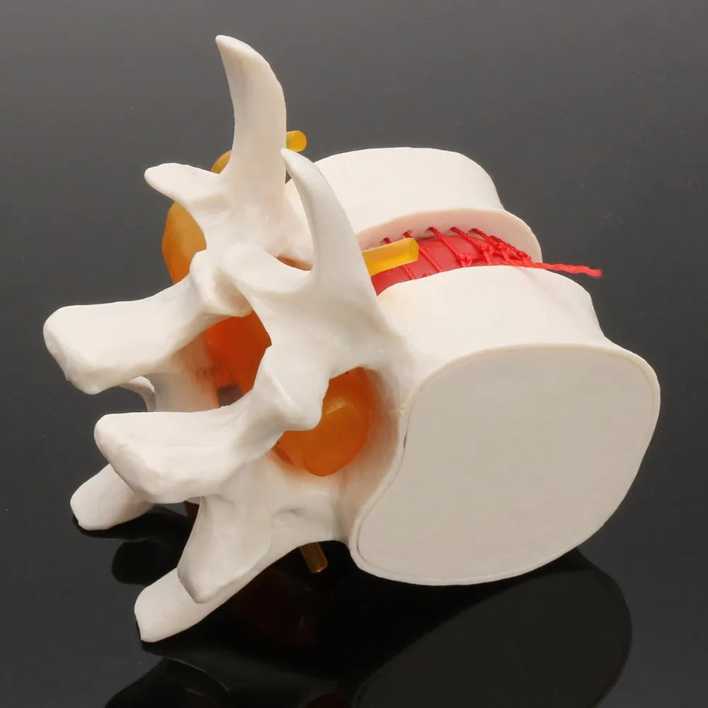 White PVC medical model of a lumbar intervertebral disc showing herniation.