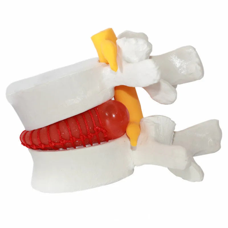 White PVC medical model of a lumbar intervertebral disc showing herniation.