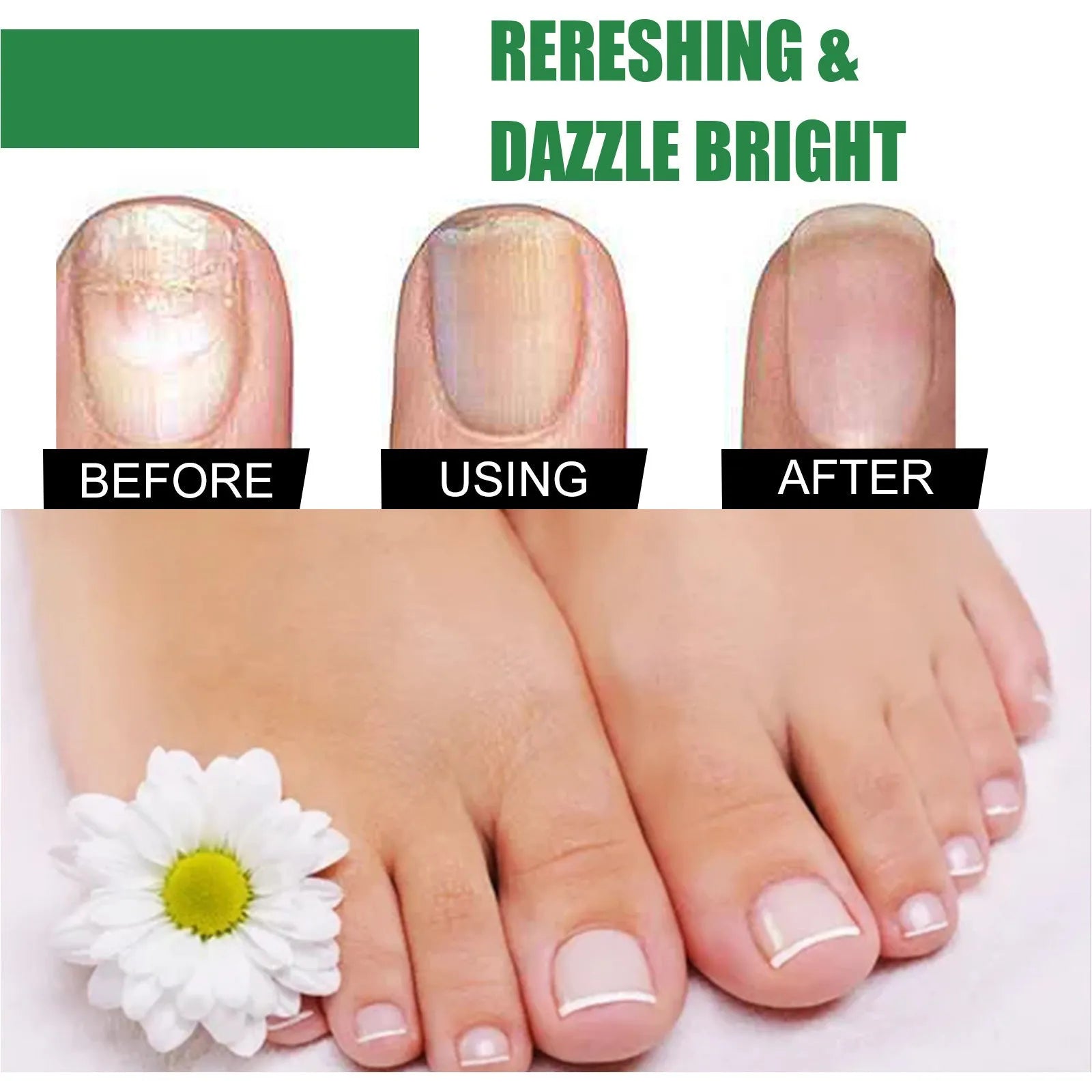 30ml bottle of tea tree oil foot and nail care solution for finger and toenail nutrition
