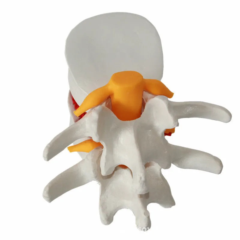 White PVC medical model of a lumbar intervertebral disc showing herniation.