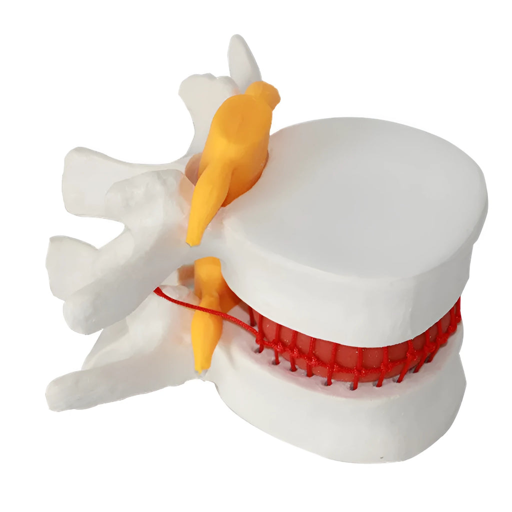 White PVC medical model of a lumbar intervertebral disc showing herniation.