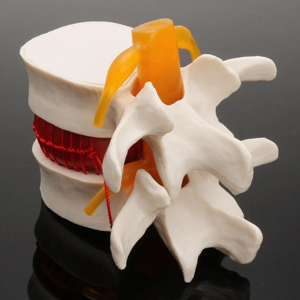 White PVC medical model of a lumbar intervertebral disc showing herniation.