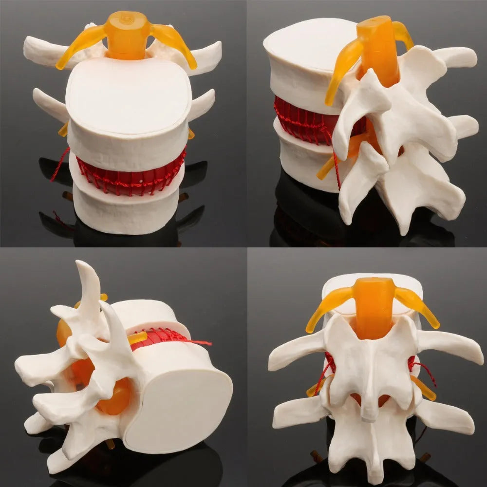 White PVC medical model of a lumbar intervertebral disc showing herniation.