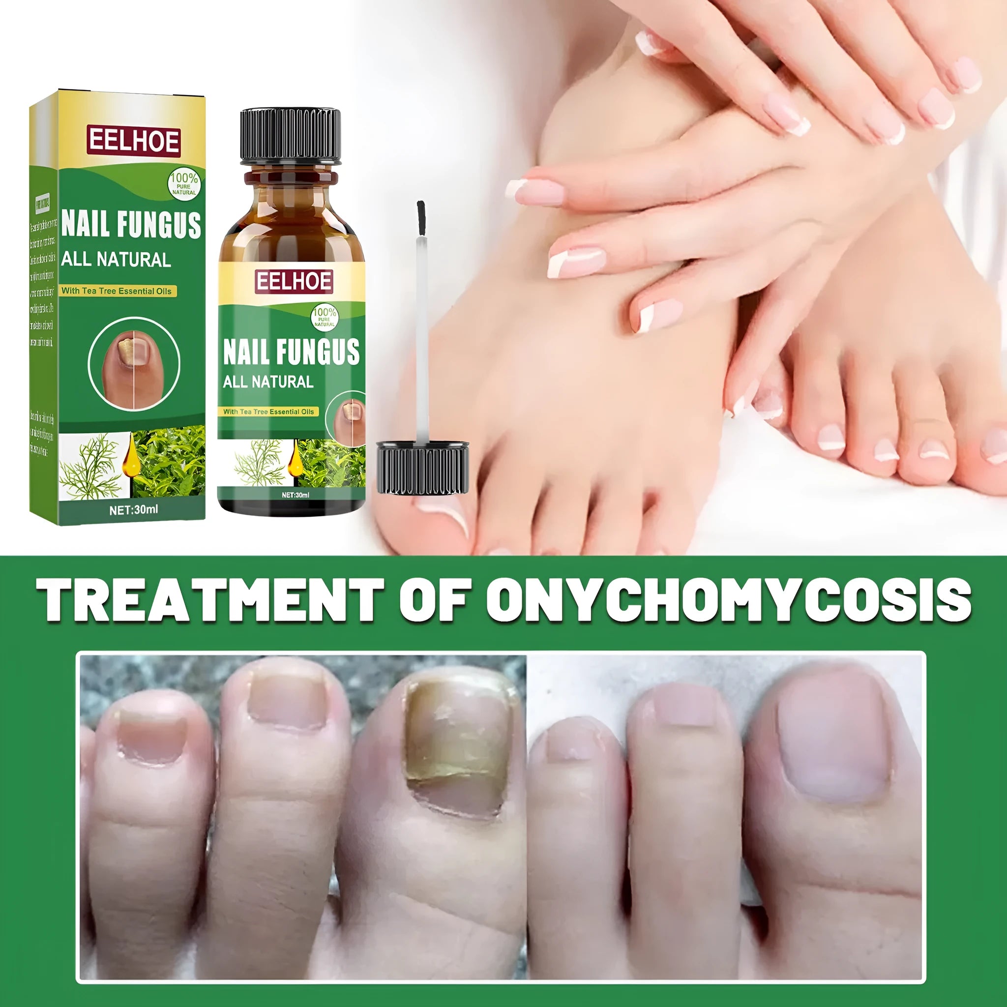 30ml bottle of tea tree oil foot and nail care solution for finger and toenail nutrition
