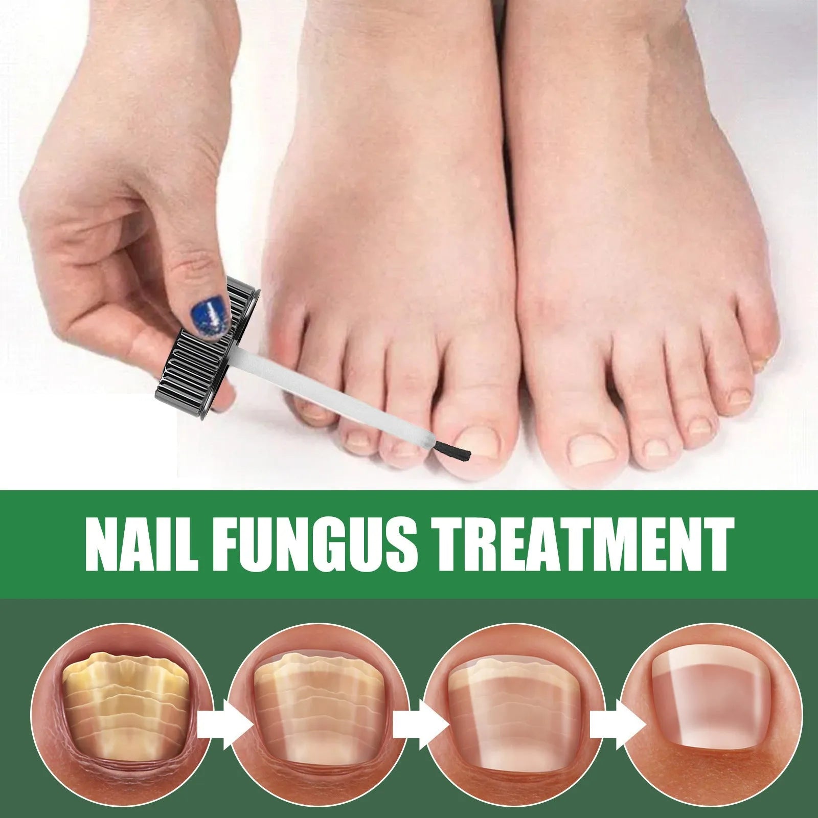 30ml bottle of tea tree oil foot and nail care solution for finger and toenail nutrition