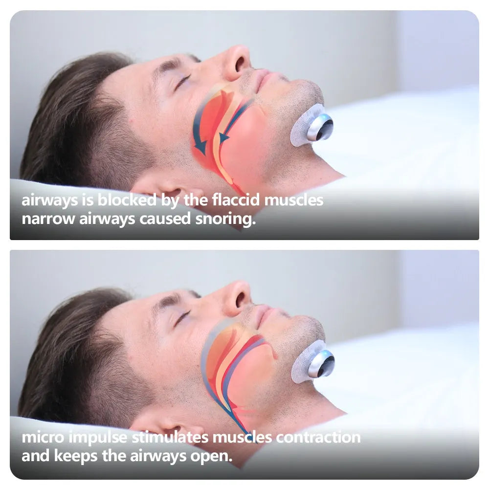Smart anti-snoring device with electronic muscle stimulator and twenty conductive strips